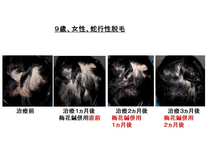 円形脱毛症　病院